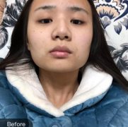 濟南中心醫(yī)院整形科做下頜角案例果圖！再分享價格費用信息2021