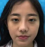 常州一院整形科做鼻子價格表2021！在分享真實案例果圖