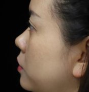 浙醫(yī)二院整形科做熱瑪吉怎么樣？專家案例、價格表清單一一盡顯！