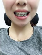 北大口腔醫(yī)院牙齒矯正怎么樣？案例實(shí)際果和價格表一覽！