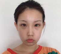 成都八大處整形醫(yī)院隆鼻案例曝光！還有價(jià)格收費(fèi)明細(xì)參考