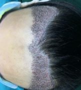 寧波市第六醫(yī)院整復(fù)外科種植發(fā)際線怎么樣？請(qǐng)看案例前后圖片及價(jià)格收費(fèi)