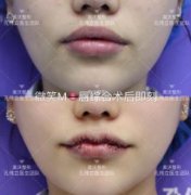 厚嘴唇的原因是什么?影響嘴唇形狀的壞習(xí)慣有哪些?