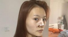 浙一醫(yī)院鼻部手術手術案例分享!鼻翼縮小術價格是多少錢?