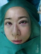 蘭州市第二人民醫(yī)院整形科全切雙眼皮案例果分享！前后變化太贊了