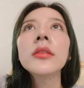 鼻小柱整形有什么優(yōu)勢？