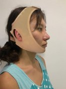 整形醫(yī)院面部輪廓價(jià)格價(jià)目表公開(kāi)!含實(shí)拍案例圖分享!