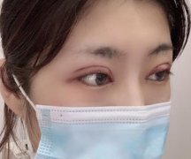 佛山市第一人民醫(yī)院美容科好嗎？雙眼皮案例及價格收費表公開對比