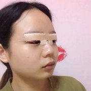 清遠(yuǎn)市人民醫(yī)院整形雙眼皮怎么樣？實(shí)拍眼部手術(shù)案例和價(jià)格收費(fèi)公開