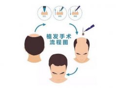 發(fā)際線植發(fā)的價(jià)格是多少?植發(fā)前需要做哪些準(zhǔn)備?