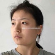 北京美萊做抗衰除皺相關(guān)價格收費參考~含熱瑪吉案例術(shù)后反饋圖