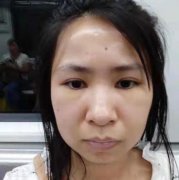 南京省中醫(yī)整形美容科怎么樣？祛眼袋案例+價(jià)格收費(fèi)標(biāo)準(zhǔn)公布