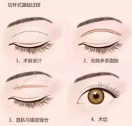 全切雙眼皮的優(yōu)勢和劣勢是什么?全切雙眼皮手術(shù)后如何護理?