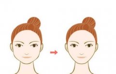 下頜骨手術(shù)切口位置在哪里？做下頜骨整形好嗎?