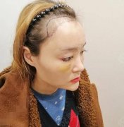 成都華西醫(yī)院植發(fā)果好嗎？?jī)r(jià)格貴嗎？發(fā)際線(xiàn)種植案例測(cè)評(píng)和價(jià)格參考