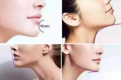 廣州下巴整形價格是多少錢?整容豐下巴的價格影響因素有哪些?