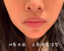 怎么讓嘴皮變薄?厚唇改薄術(shù)恢復(fù)時間要多久?