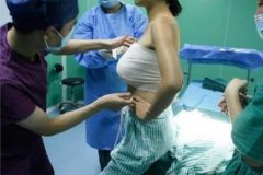 2022隆胸價格表上線了嗎？什么因素會影響隆胸的價格?