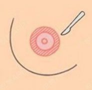 乳暈再造后有疤痕嗎?