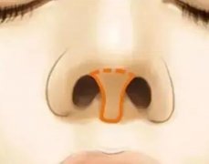 鼻小柱畸形矯正手術(shù)的適宜人群又哪些?矯正手術(shù)調(diào)節(jié)小柱畸形多少錢(qián)?