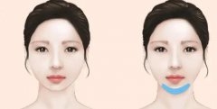 假體墊下巴多少錢(qián)?假體墊下巴術(shù)后護(hù)理有幾種?