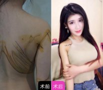 抽脂豐胸的一般費(fèi)用是多少?抽脂豐胸后需要注意哪些點(diǎn)?