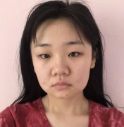 上海新華醫(yī)院整形外科熱瑪吉案例，授權(quán)證書+價格費用參考！