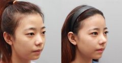 自體軟骨隆鼻價格多少?　自體軟骨隆鼻有哪些優(yōu)勢?