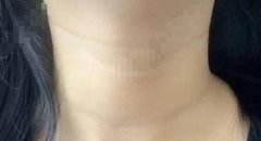 杭州市三醫(yī)院美容科去頸紋怎么樣？手術(shù)案例及價格明細全新發(fā)布