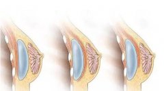 豐胸多少錢?豐胸沒問題嗎?