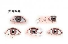 什么樣的人適合開眼角?