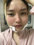 蘇州大學(xué)附屬第二醫(yī)院整形科面部吸脂案例！多組照片及價(jià)格標(biāo)準(zhǔn)展示