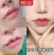 唇部整形疼嗎?手術(shù)后多久會腫?