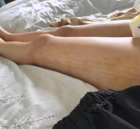 腿部抽脂怎么才能恢復(fù)較快?腿部抽脂一次多少錢(qián)?