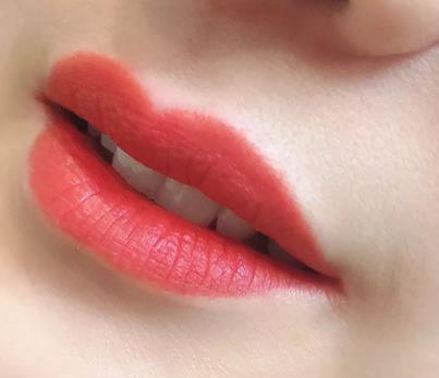 紋唇有哪些手術(shù)方法?如何避免嘴唇發(fā)黑?