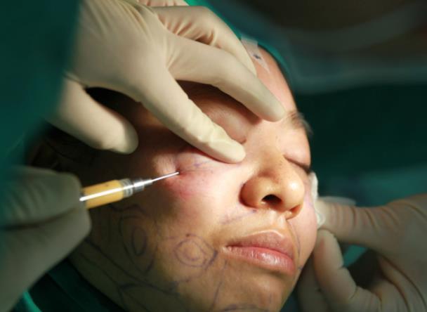 有雙下巴怎么辦?選擇雙下巴面部吸脂靠譜嗎?