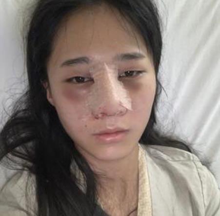 上海時光整形外科醫(yī)院隆鼻案例_果圖和價格表在線一覽