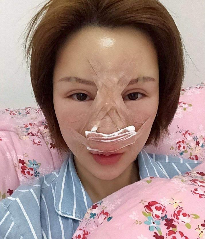 長沙市美之峰做隆鼻+全臉脂肪填充案例_項(xiàng)目價(jià)格收費(fèi)展示