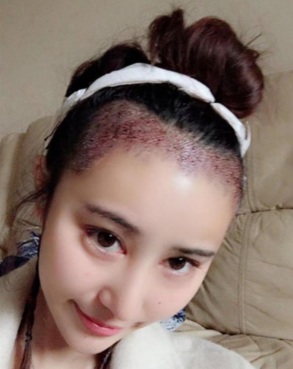 北京中日友好醫(yī)院發(fā)際線種植案例&價格表搶先看