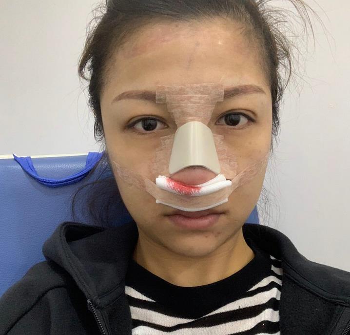 天津維美整形價格表搶先一覽！含經(jīng)典鼻修復(fù)案例