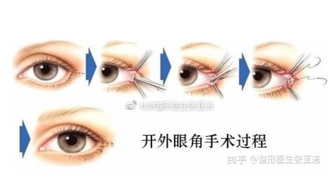 眼角修復后的護理?哪些情況需要修復?