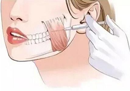 咬肌切除術(shù)是怎么做的?咬肌切除術(shù)的術(shù)后護(hù)理要注意什么?