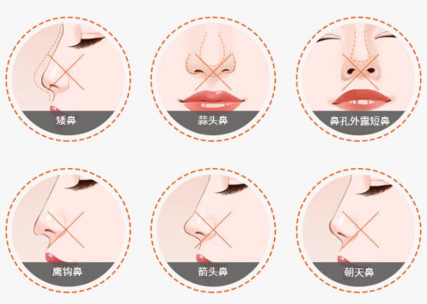 耳軟骨隆鼻之后多久才能恢復(fù)?什么是耳軟骨隆鼻?