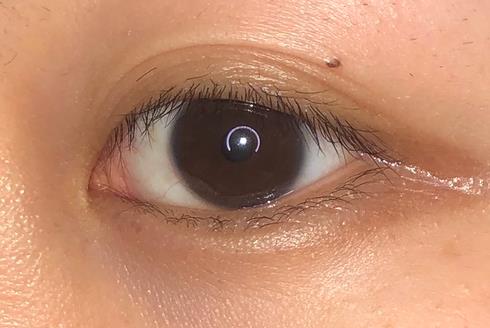 武漢開(kāi)內(nèi)眼角會(huì)回縮嗎?為什么開(kāi)內(nèi)眼角手術(shù)后眼角縮回?