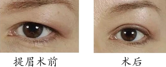 微創(chuàng)提眉術(shù)和縫合提眉術(shù)哪個好?免縫合提眉怎么做的?