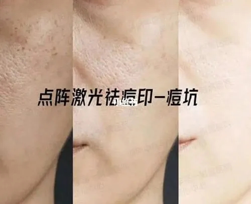 能用激光去除痘印嗎，有什么副作用？還有療程大公開