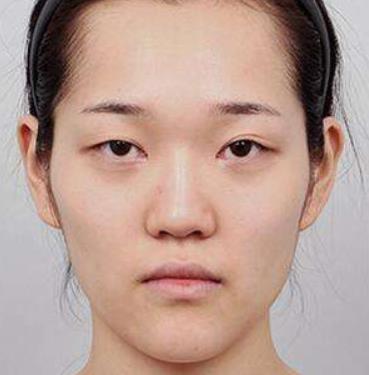 知識寶典 | 眼瞼下垂的矯正原理是什么?