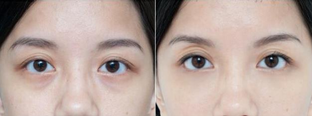 眼袋整形的價格及去眼袋果能持續(xù)多久