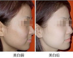 美白能不能自己打？美白前的注意事項