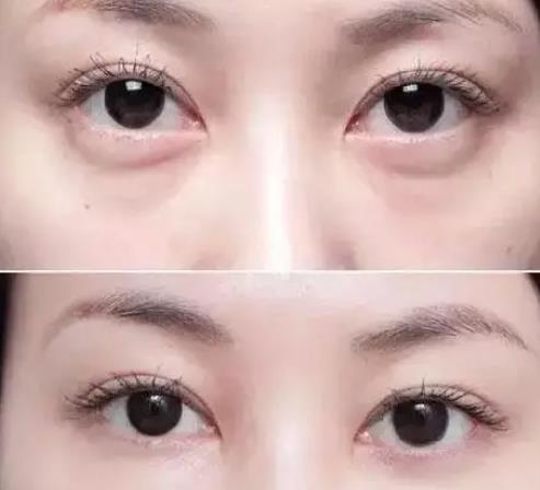真相 | 填充淚溝的價(jià)格是多少？淚溝類(lèi)型有哪些？